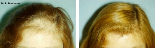 avant-après greffe cheveux femme