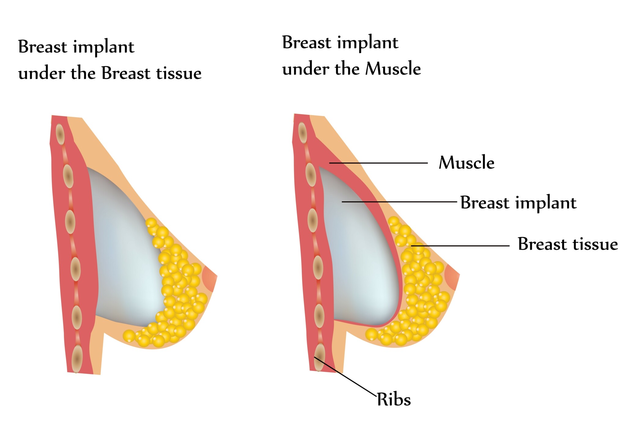 Emily Skye Breast Implants