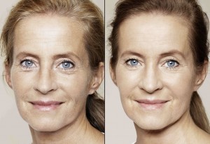 Mésothérapie visage pour réhydrater en profondeur la peau