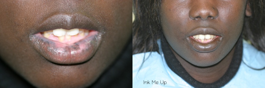 dermopigmentation réparatrice sur vitiligo des lèvres
