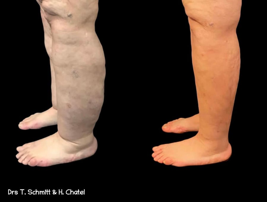 Maladie des jambes poteaux (lipœdème) : des solutions existent pour contrer  ses effets indésirables