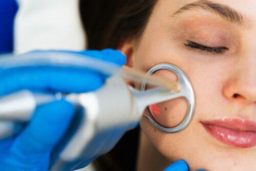 Laser chez le dermato : des tips pour alléger la facture